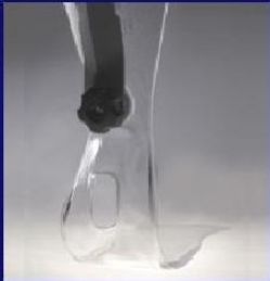 Corrxit Foot Orthoses with Transfer Attachment